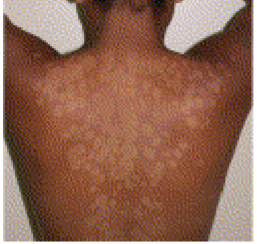 <p>Pityriasis versicolor presentation</p>