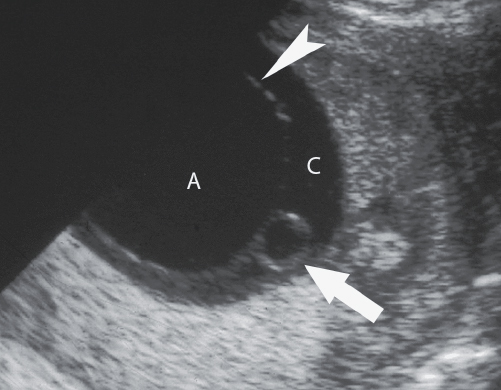 <p></p><p>18. What does the white arrowhead in Figure 23-37 indicate?</p><p>a. Chorion</p><p>b. Chorionic cavity</p><p>c. Amnion</p><p>d. Gestational sac</p>