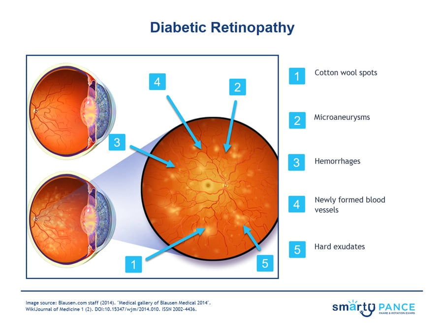 <p>Early stage of diabetic retinopathy in which the symptoms are mild or nonexistent</p><p>-Fundoscopy shows → microaneurysms, hard exudates, cotton wool spots, blot and dot hemorrhages, and venous dilation </p><p>-Tx: manage blood sugar, get yearly dilated eye exam </p>