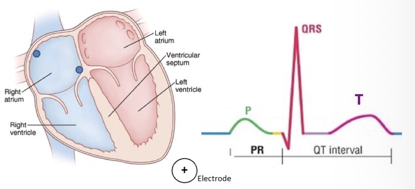<p>Repolarisation of ventricles (resting phase)</p><ul><li><p>Wave after the ST segment</p></li></ul><ul><li><p>Part of the QT interval</p></li><li><p>QTc interval should be less than 500Msec (2.5 large boxes)</p></li></ul><p></p>