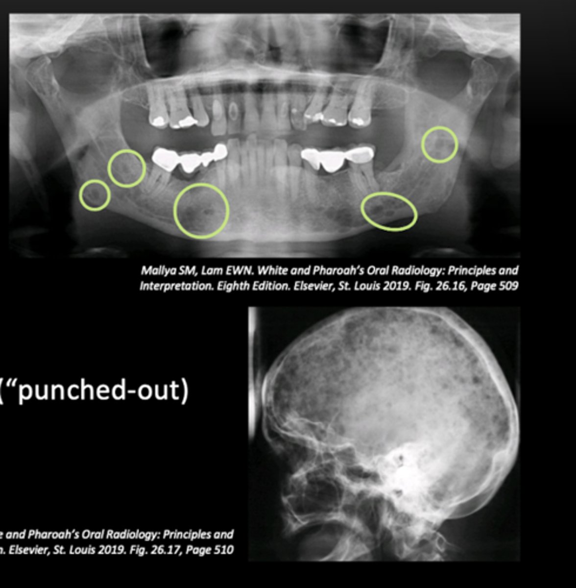 <p>- Location: multi-focal</p><p>- Shape: round</p><p>- Margins: well defined, non-corticated ("punched-out")</p><p>--> RL dots throughout</p>