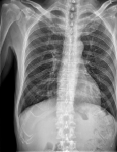 <p>the included image has an example of a thoracic abnormality; what is it?</p>