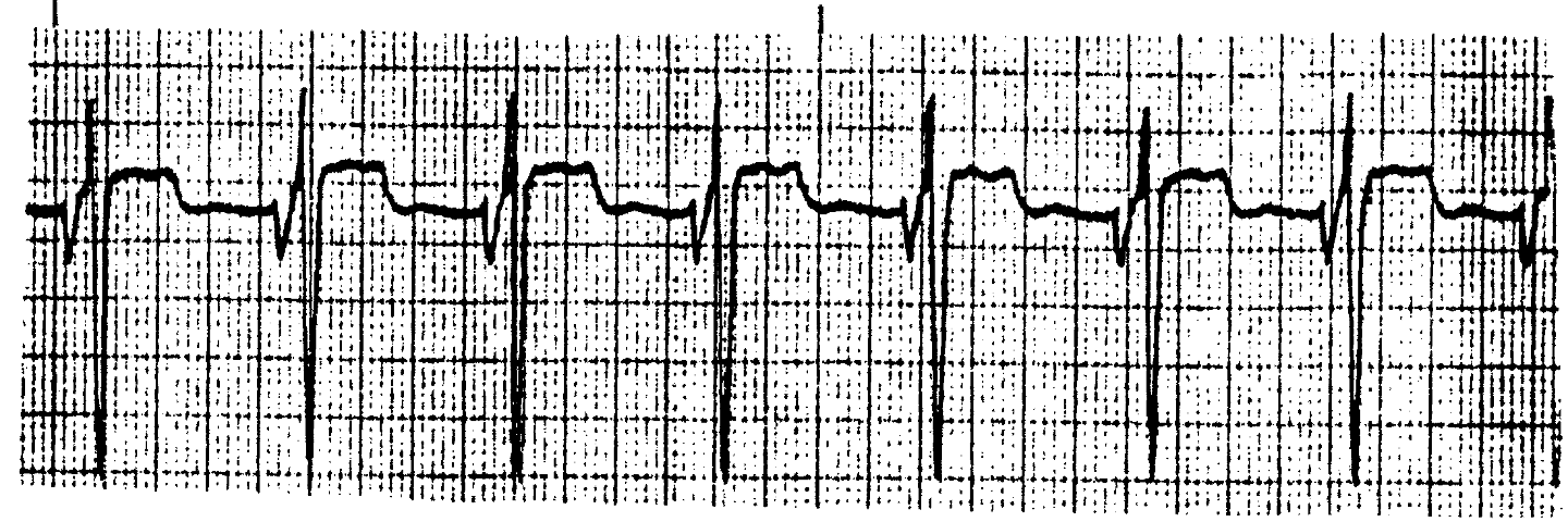 <p>What ECG is this? </p>