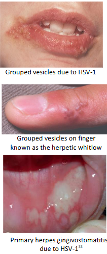 <ul><li><p>enveloped dsDNA, herpesviridae</p></li><li><p>oral or genital vesicular lesions, keratoconjunctivitis, meningoencephalitis, sepsis, hepatic failure</p><ul><li><p>multinucleated giant cell</p></li></ul></li></ul><p></p>