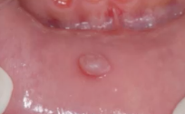 <p>LOWER lip lesion due to REACTIVE process with smooth pink surface</p>