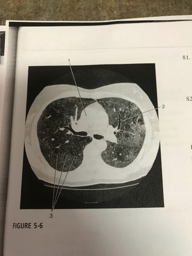 <p>Number 2 on the figure corresponds to which of the following?</p><p>A) Left mainstem bronchus </p><p>B) anterior segment of the left upper lobe bronchus </p><p>C) posterior segment of left upper lob bronchus </p><p>D) anterior segment of left lower lobe bronchus </p><p></p>