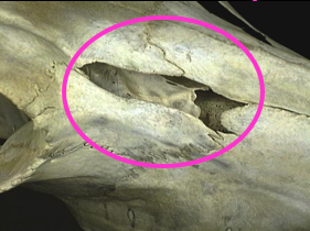 <p><span>Gap or hole between nasal and lacrimal bones</span></p>