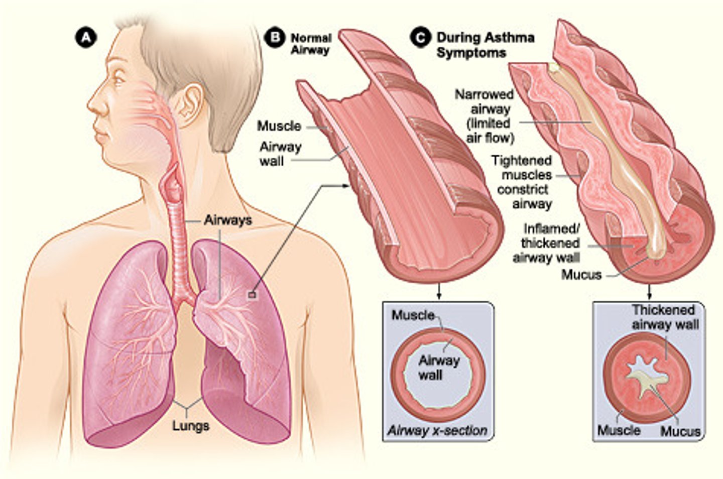 <p>A lung disease characterized by inflamed, narrowed airways and difficulty breathing.</p>