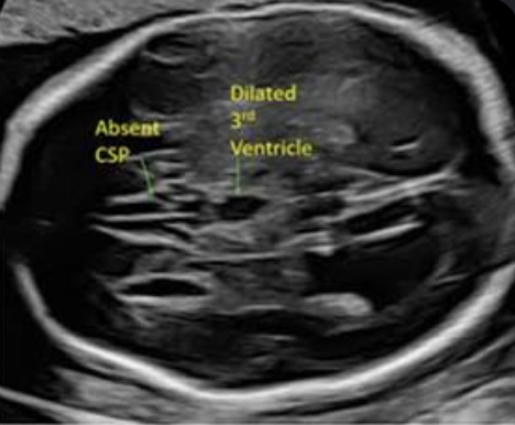 <ul><li><p>dilated 3rd ventricle </p></li><li><p>absent CSP</p></li><li><p>dilated occipital horn</p></li><li><p>outward angle of frontal and lateral horns (steer sign) </p></li></ul><p></p>