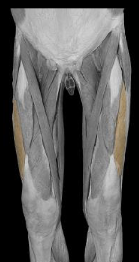 <p>insertion of vastus lateralis</p>