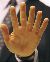 <p>extra fingers including vestigial remnants that are on the ulnar side of hand or lateral side of foot. The most common type of polydactyly, and the most frequently associated with genetic syndromes</p>