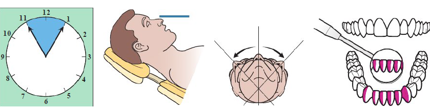 <ul><li><p>Clinician sits 11 to 1 o’clock position</p></li><li><p>Patient chin DOWN</p></li><li><p>Mandibular occlusal parallel to floor</p></li><li><p>Patient head: Neutral, left, or right</p></li></ul><p></p>