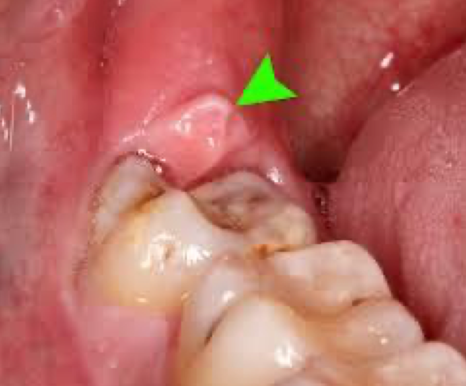<ul><li><p>Inflammation of flap covering partially erupted molar (mostly 3rd molars) </p></li><li><p>Food trap leads to bacterial growth. Very painful due to occlusal trauma </p></li><li><p>Managed via debridement, antibiotics, chlorhexidine, extraction</p></li></ul><p></p>