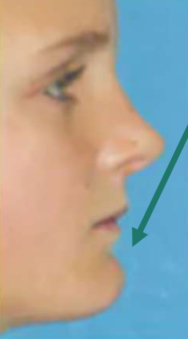 <p>(deep/shallow) mentolabial fold</p>