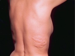 <p>Areas of rough, leathery, orange peel-like skin typically seen on the lower back or nape of the neck in tuberous sclerosis</p>