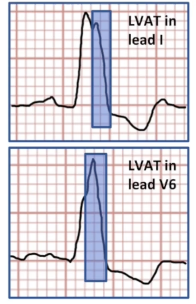 <ul><li><p>Best results with LBBB</p></li><li><p>Results improved with wider QRS</p></li><li><p>Longer LV activation time</p><ul><li><p>Time difference between first notch after 40 ms of QRS and end of QRS</p></li></ul></li></ul><p></p>