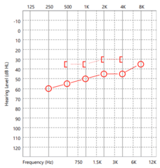 <p>what is the degree of hearing loss?</p>