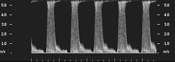 <p>Based on the Doppler image, which finding best characterizes the hemodynamics at the sampled site?</p>