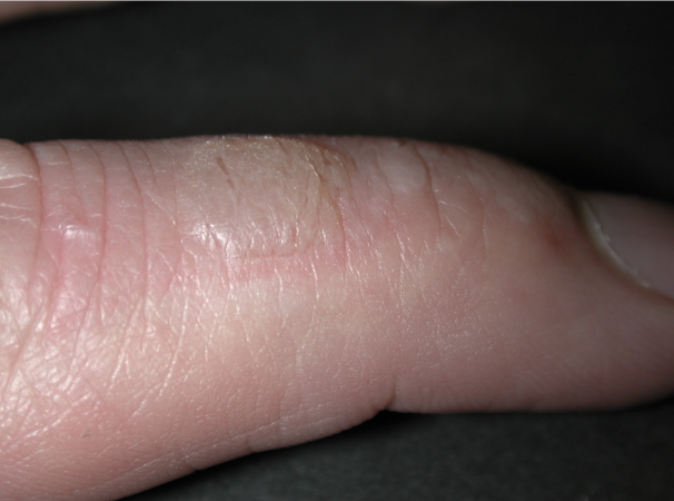 <p>What type of exudate is shown?</p>