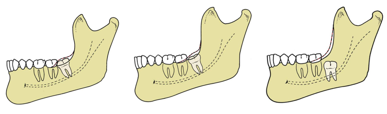 <p>-PBI: tooth partially erupted but still stuck in bone</p><p>-FBI: tooth fully in bone</p>