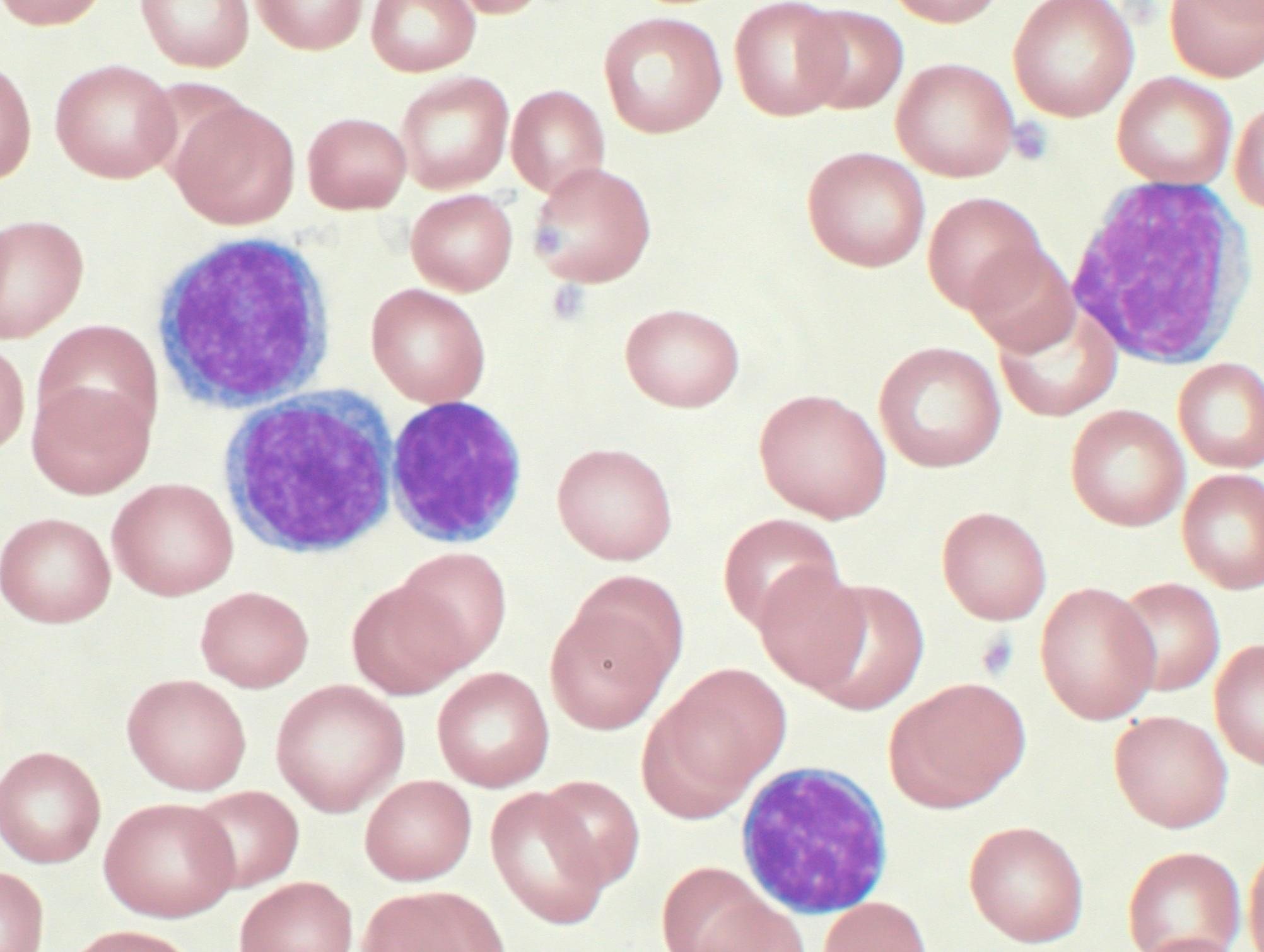 <p>CHRONIC LYMPHOCYTIC LEUKEMIA</p>