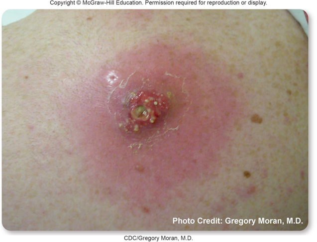 <p>Causative Agent: Staphylococcus aureus</p><p>Symptoms/Signs: Raised, red, tender, localized lesions or boils; exuding pus; hot to the touch; possible fever.</p>