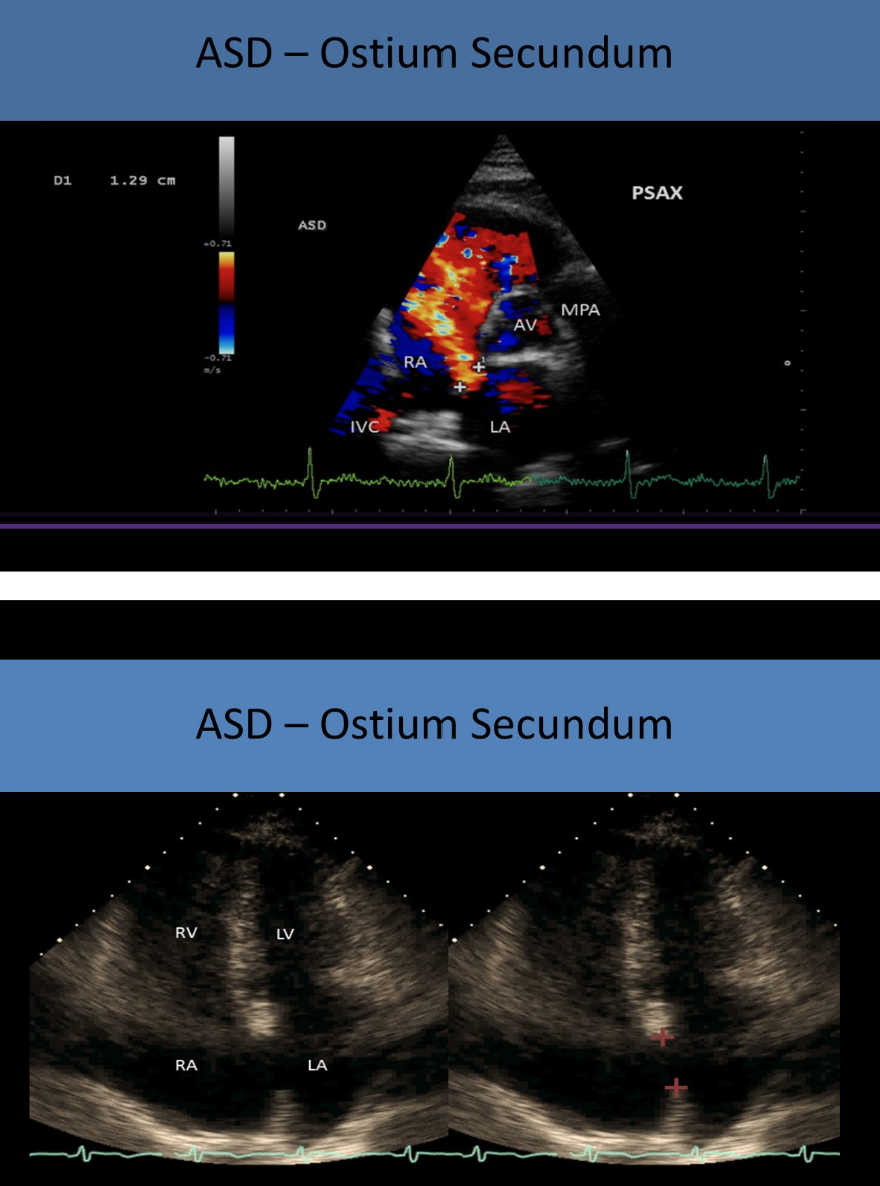<p>mid septal area </p>