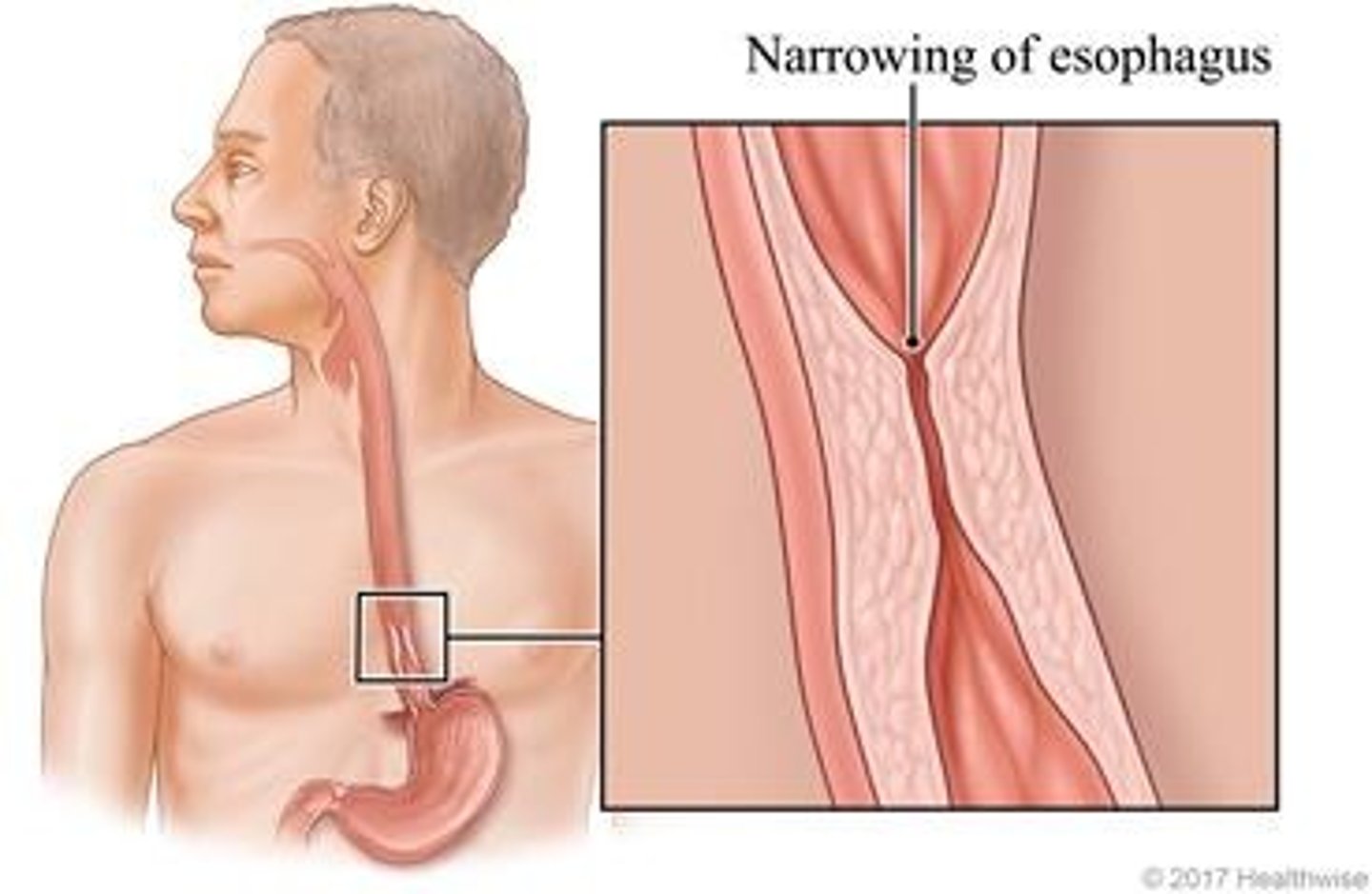 <p>Abnormal narrowing of the esophagus due to scar tissue or other damage</p>