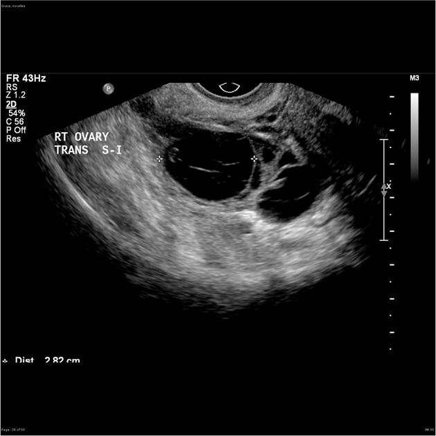 <p>Complication of PID characterized by acute lower abdominal pain, vaginal discharge, systemic symptoms, and unilateral adnexal tenderness on physical exam </p><p>-Ruptured leads to sx of acute abdomen + sepsis </p><p>-Dx: TVUS </p><p>-Tx: inpatient abx (ceftriaxone + doxy + metro) and surgical intervention </p>