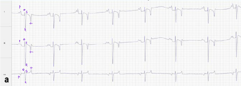<p>p-wave: Represents atrial depolarization (interatrial flash of depolarization + flash to AV node), caused by firing of the SA node</p><p>QRS Complex - Represents ventricular depolarization (atrial repolarization also takes place here but is masked by the larger ventricular depolarization)</p><p>T wave - Represents ventricular repolarization following depolarization</p>