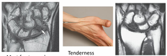 <p>Tenderness in the anatomic "snuff box"</p>