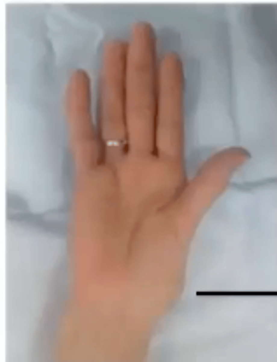 <p>Median n. Injury</p><p>-wasting of the thenar eminence</p><p>-flat hand/palm (lack of opposition)</p><p>---less prominent arches</p>