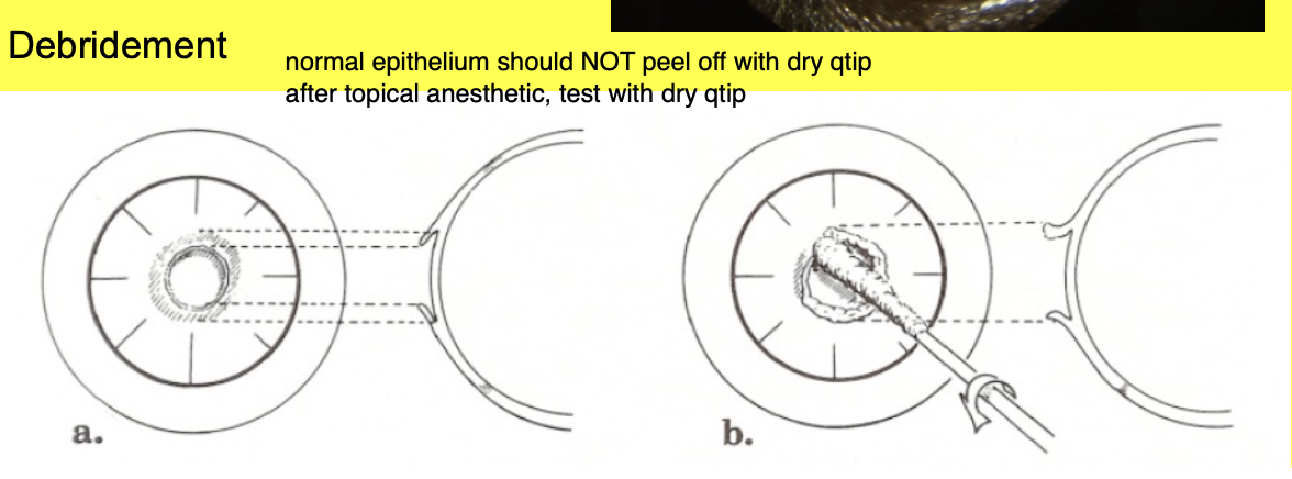 <p>normal epithelium will not peel off w/ a Q-tip.</p>