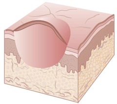 <p>Primary lesion; Solid elevation of less than 1 cm in diameter and has distinct borders (ex: a small raised pimple)</p>
