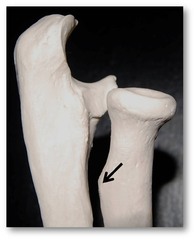<p>Bump on the radius under the neck of the radius</p>