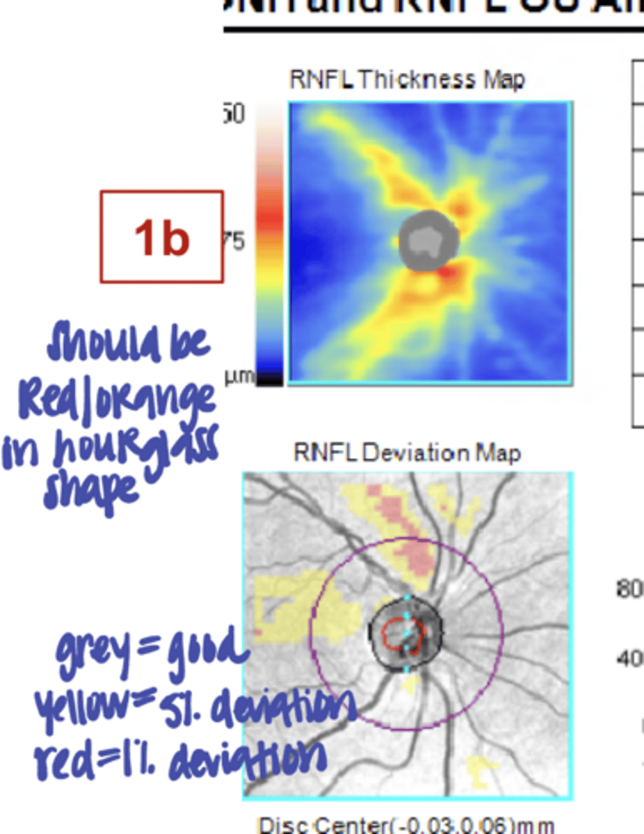 <p>On the RNFL thickness map, the red/orange color should be in a _____ shape</p>