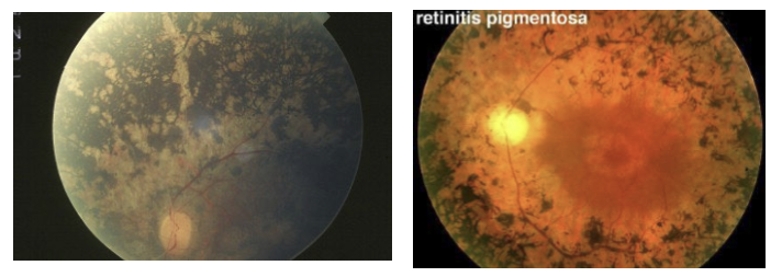 <p>Pigment clumping in peripheral retina that has “bone spicule” appearance is a classic sign. Also attenuated retinal arteries. </p>