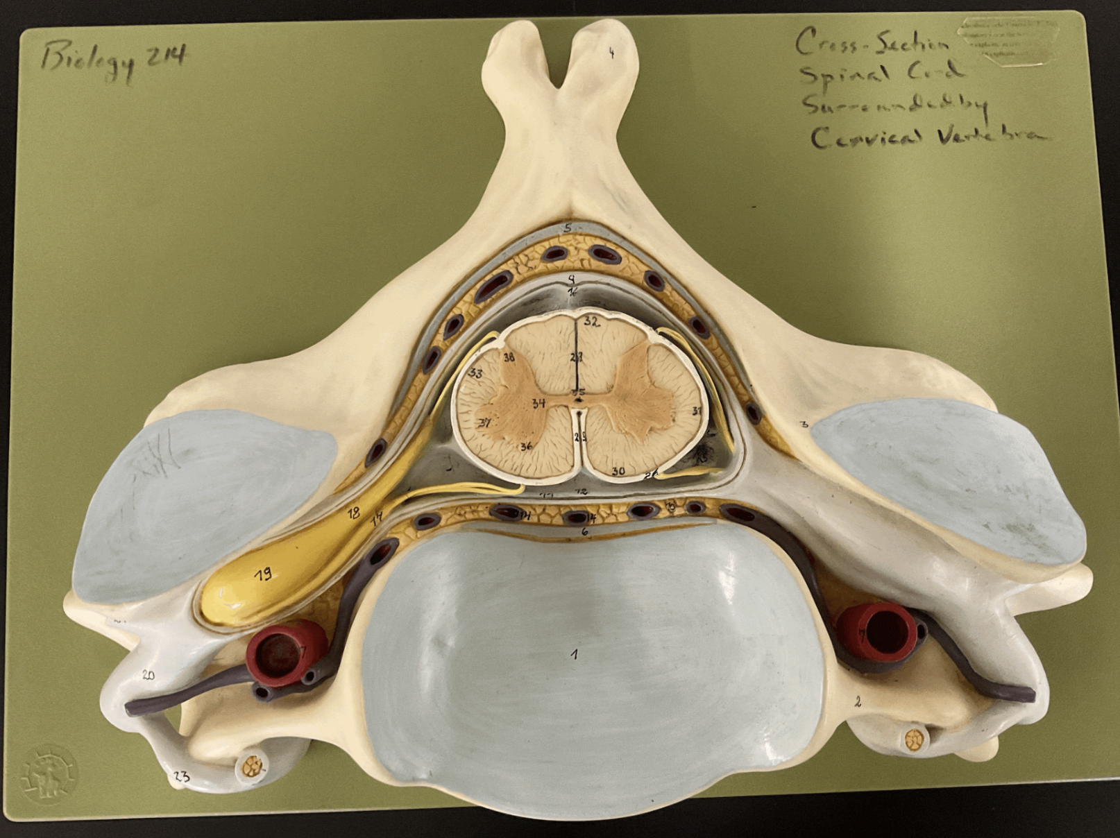 <p>13, outside pia mater</p>