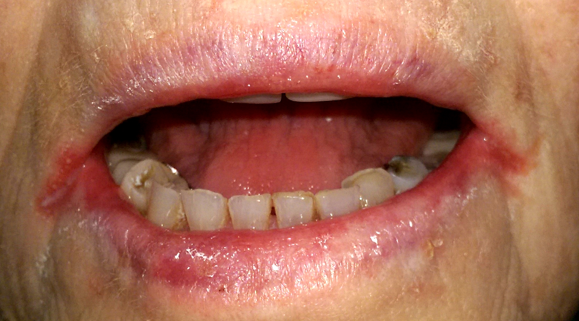 <p>What is this lesion?</p>