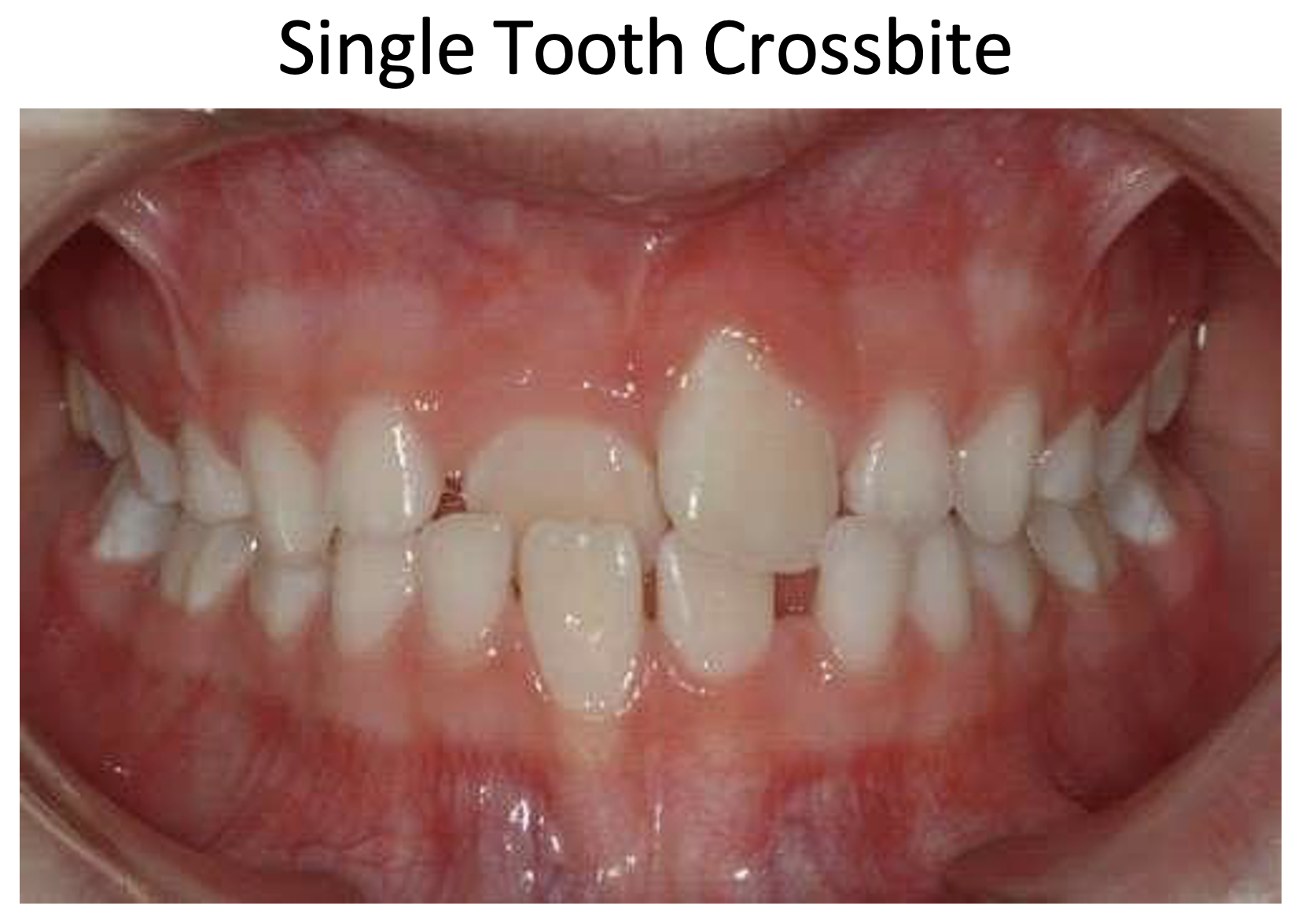 <p>Crossbite </p>