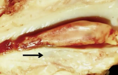 <p>tail extends in the direction of blood flow and partially occludes vessel</p>