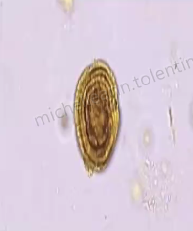 <p><span style="line-height: 1.5;"><strong>Yellow-brown spheres that demon</strong>strate concentric circles and radial striations:&nbsp;</span></p><p></p><p><span style="line-height: 1.5;">Bilirubin crystals</span></p><p><span style="line-height: 1.5;">Leucine crystals</span></p><p><span style="line-height: 1.5;">Tyrosine crystals</span></p><p><span style="line-height: 1.5;">Uric acid crystals</span></p>