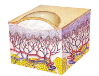 <ul><li><p>circumscribed, elevated lesion with <strong>serous fluid</strong></p></li><li><p>superficial</p></li><li><p><5mm in diameter</p></li></ul><p></p>