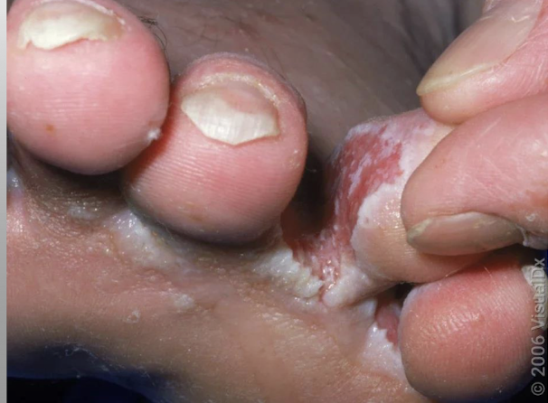 <p>caused by various dermatophytes </p><p>manifestations: interdigital scaling and maceration; scaly skin, may be peeling</p><p>treatment: topical antifungal agents, keeping feet clean and dry, allow feet to have air, wear shoes in public showers </p>