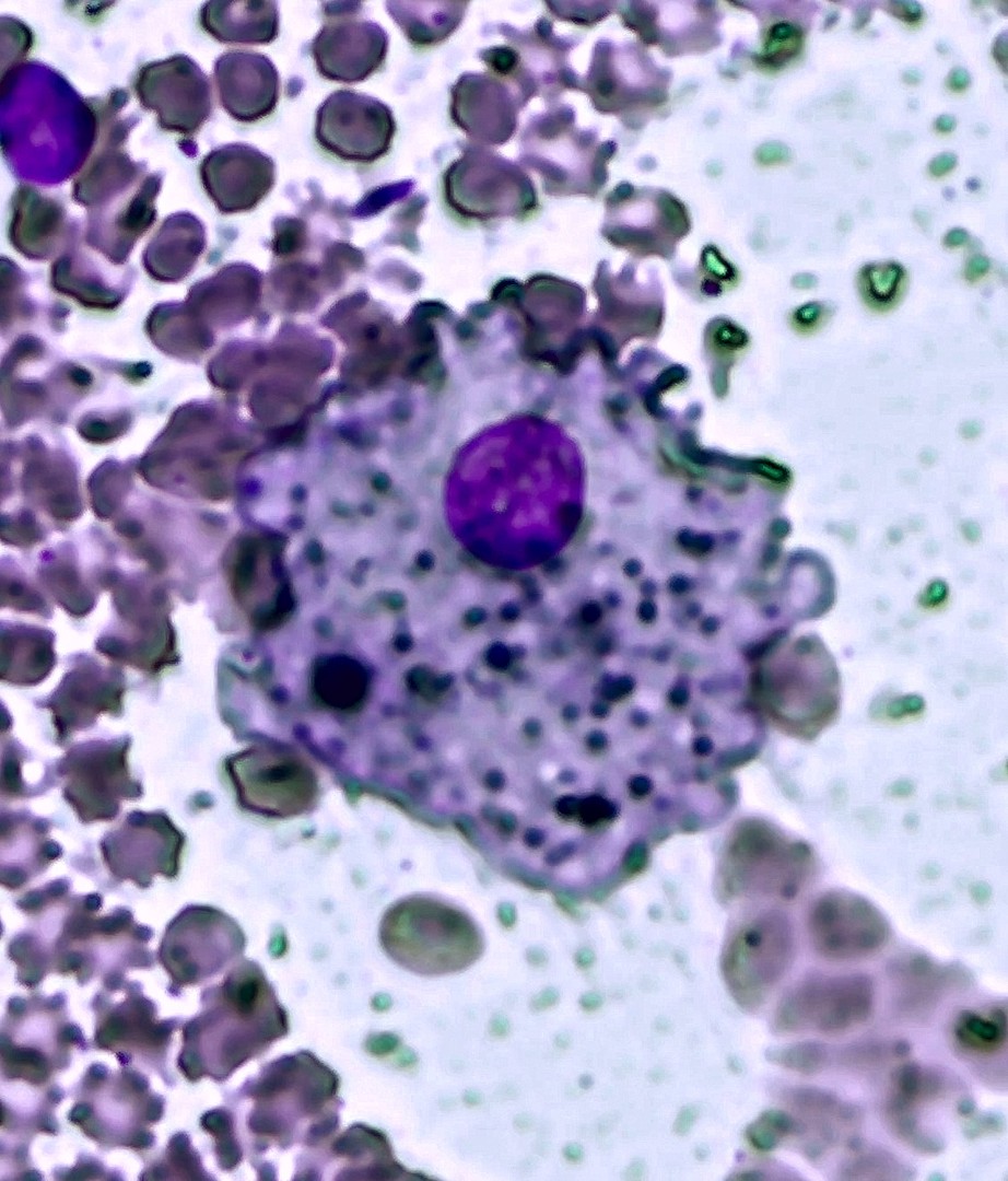 <ul><li><p>Hemo: <span>macrophages that have ingested </span><strong>hemosiderin; </strong>have iron deposits in cytoplasm</p></li><li><p>Signet: <span>macrophages that contain </span><strong>large, clear cytoplasmic vacuoles</strong><span> that push the nucleus to the periphery → “signet-ring” appearance</span></p></li></ul><p></p>