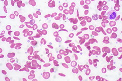 <p>aniso, poik, sickle cells, target cells, nRBCs, HJ bodies, basophilic stippling, siderotic granules, polychromasia, retics 10-20%, increased WBC w/ shift to left and increased platelets</p>