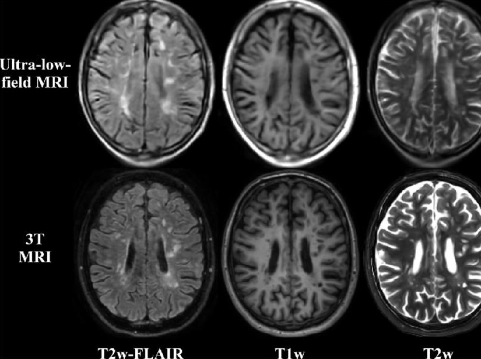 <p>Compared with 3T MRI:</p><p>Ultra-low-field MRI demonstrates:</p><ul><li><p>blurred cortical anatomy,</p></li><li><p>difficulty identifying gyri and sulci,</p></li><li><p>poorer white matter definition,</p></li><li><p>larger pixel size,</p></li><li><p>reduced visibility of blood vessels,</p></li><li><p>poorer depiction of lesions,</p></li><li><p>reduced ability to diagnose conditions such as vascular dementia or multiple sclerosis.</p></li></ul><p></p>
