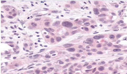<p>How would you grade this infiltrative ductal carcinoma?</p>