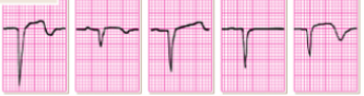 <p>what does this EKG show? </p>