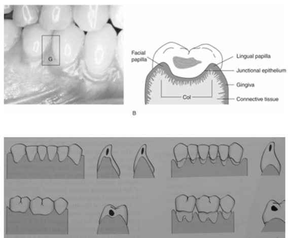 <p>⢠Occupies Gingival Embrasure</p><p class="p1">⢠Pyramidal or āColā Shaped</p><p class="p1">⢠The shape of the interdental tissue depends on the contact point of the adjacent teeth and the presence or absence of recession</p>